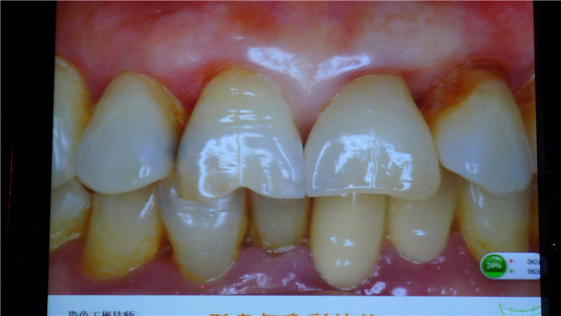 牙齿美容